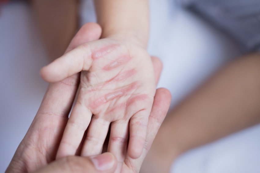 BIOPTRON® HYPERLIGHT ÜBERTRIFFT NIEDRIGENERGIE-LASERTHERAPIE DEUTLICH – NEUE KLINISCHE STUDIE BESTÄTIGT